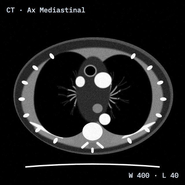 Chest CT in soft-tissue window